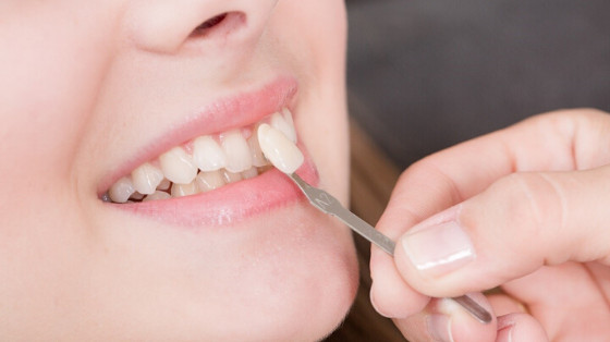 Could Veneers in Liverpool Transform Your Smile?